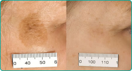Age spots before laser treatment (right) after laser treatment (left)
